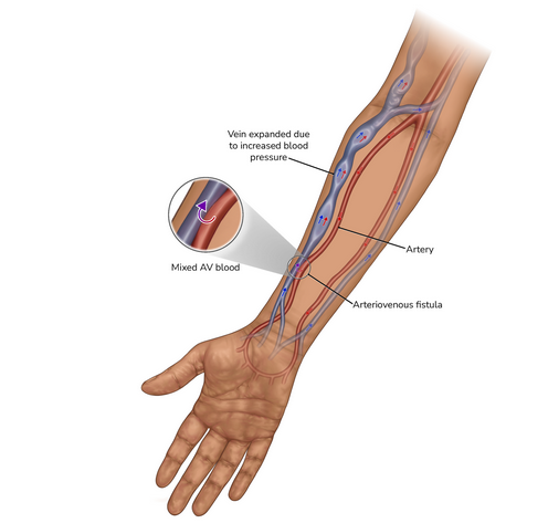 مميزات الوصلة الشريانية الوريدية 